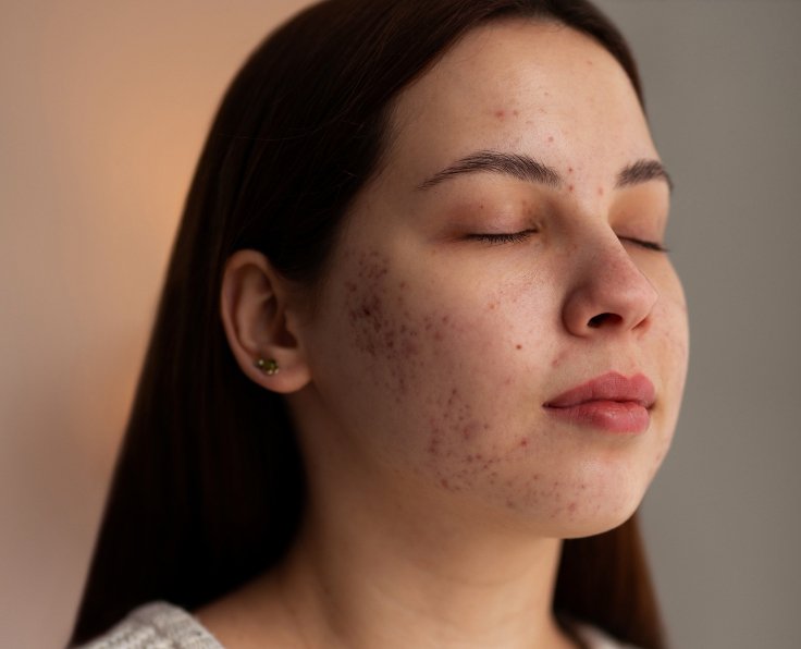 acne treatment auckland